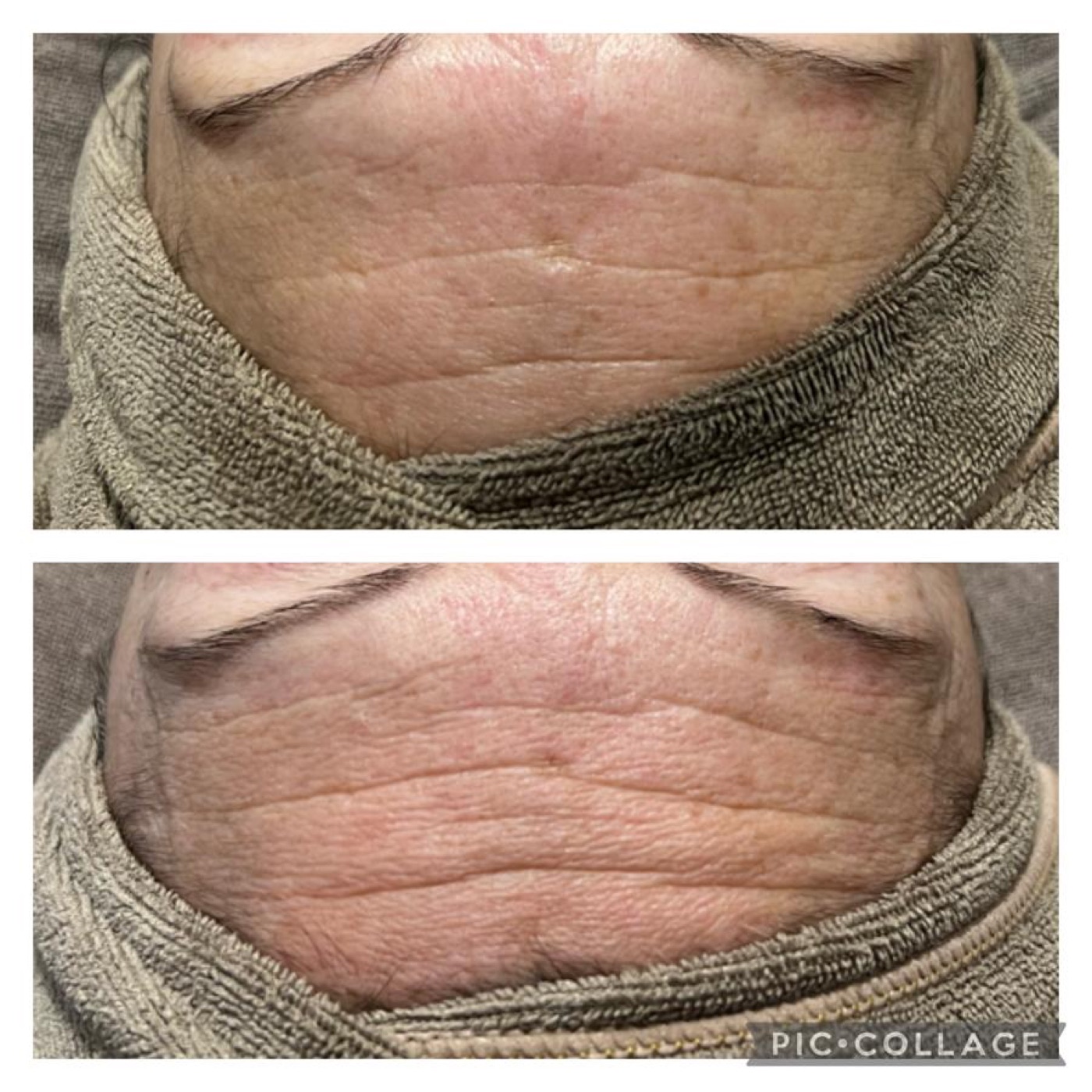 Prima e dopo di un trattamento viso, esempio 3